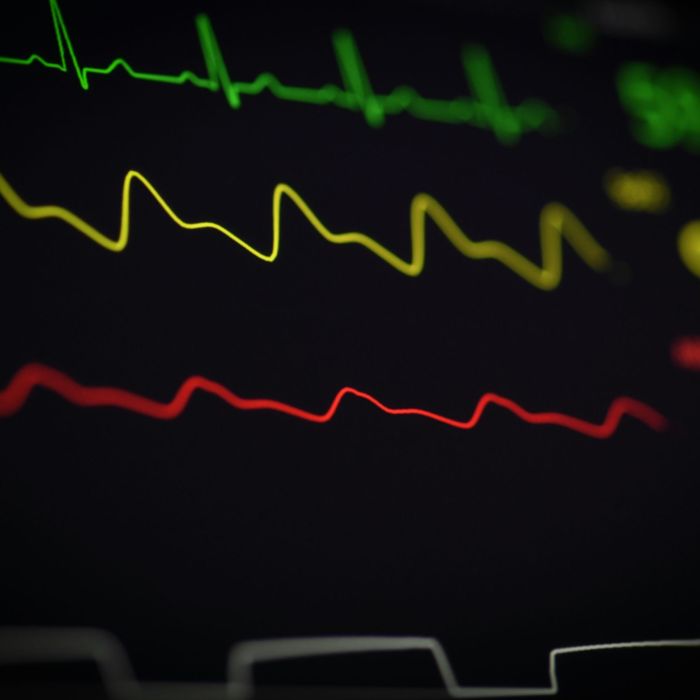 Artificial Intelligence Is Transforming Heart Disease Detection with Faster and More Accurate Diagnosis